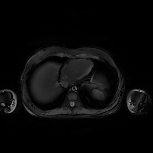 File:Normal MRI abdomen in pregnancy (Radiopaedia 88001-104541 D 6).jpg