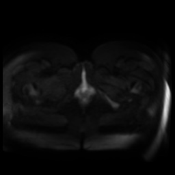 Normal MRI abdomen in pregnancy (Radiopaedia 88005-104548 Axial DWI 74).jpg