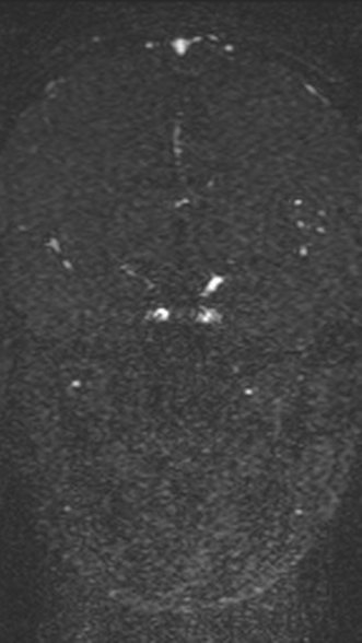 Normal MRI brain with MRV- teenager (Radiopaedia 49425-54553 Coronal MRV 117).jpg