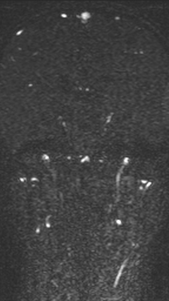 Normal MRI brain with MRV- teenager (Radiopaedia 49425-54553 Coronal MRV 139).jpg