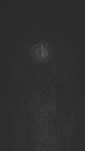 Normal MRI brain with MRV- teenager (Radiopaedia 49425-54553 Coronal MRV 28).jpg