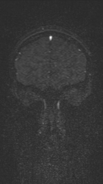 Normal MRI brain with MRV- teenager (Radiopaedia 49425-54553 Coronal MRV 53).jpg