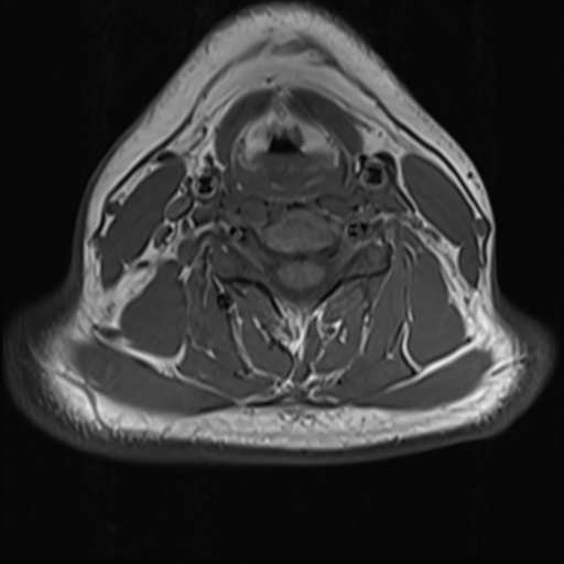 File:Normal MRI cervical spine (infection protocol) (Radiopaedia 53916-60039 Axial 29).png