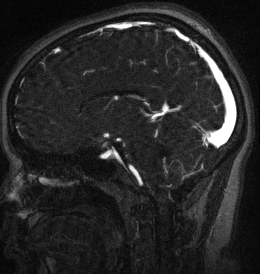 Normal brain MRI and venogram (Radiopaedia 39554-41862 Sagittal MRV 36).jpg