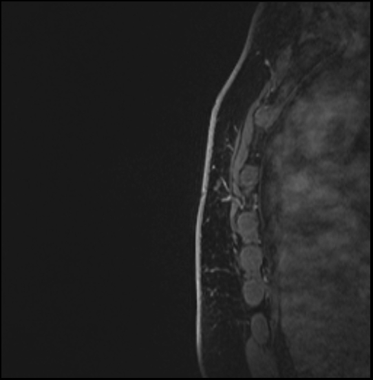Normal breast MRI - dense breasts (Radiopaedia 80454-93850 I 172).jpg