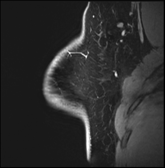 Normal breast MRI - dense breasts (Radiopaedia 80454-93850 I 45).jpg