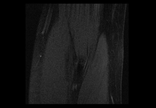 File:Normal elbow arthrograms (Radiopaedia 75550-86805 Coronal T1 fat sat 14).jpg