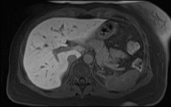 File:Normal hepatobiliary phase liver MRI (Radiopaedia 58968-66230 A 37).jpg