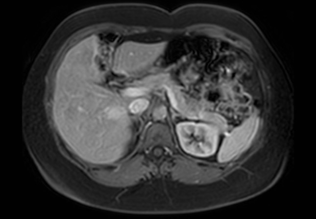 Normal liver MRI with Gadolinium (Radiopaedia 58913-66163 J 41).jpg