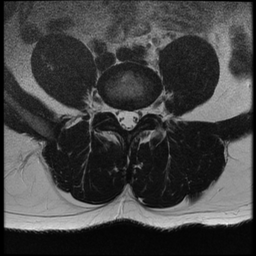 File:Normal lumbar spine MRI (Radiopaedia 35543-37039 Axial T2 14).png
