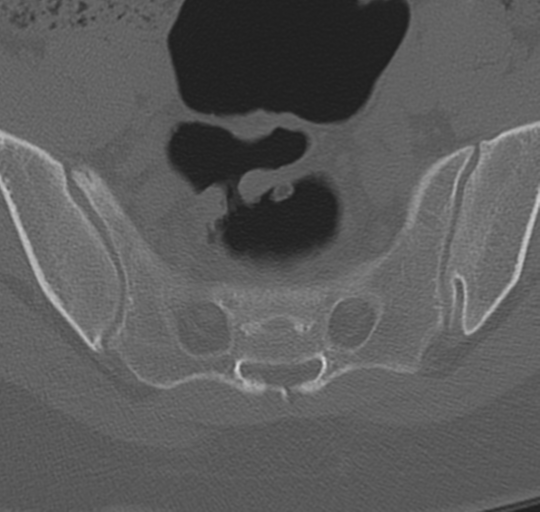 File:Normal lumbosacral CT (Radiopaedia 37923-39867 Axial bone window 92).png