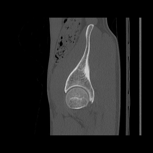 Normal pelvis (Radiopaedia 51473-57238 Sagittal bone window 35).jpg