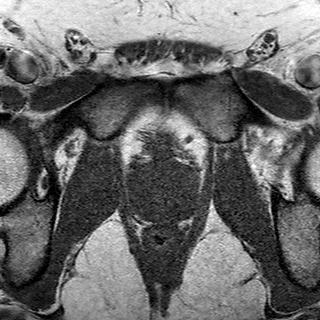 File:Normal prostate (MRI) (Radiopaedia 29986-30535 Axial T1 6).jpg