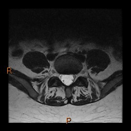 File:Normal spine MRI (Radiopaedia 77323-89408 Axial T2 22).jpg