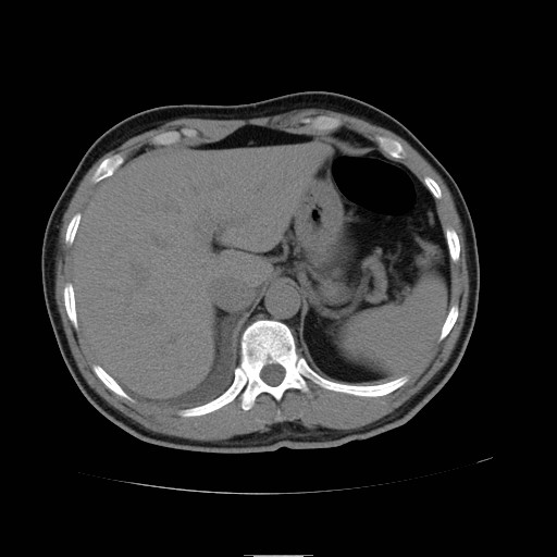File:Obstructed kidney with perinephric urinoma (Radiopaedia 26889-27066 Axial non-contrast 2).jpg