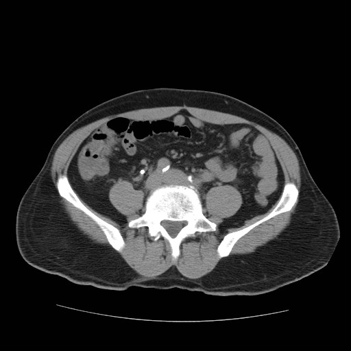 File:Obstructed kidney with perinephric urinoma (Radiopaedia 26889-27067 Axial non-contrast 5).jpg