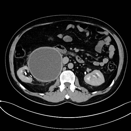 Obstructed upper pole ureter in a duplex kidney (Radiopaedia 54935-61221 Axial C+ delayed 25).jpg