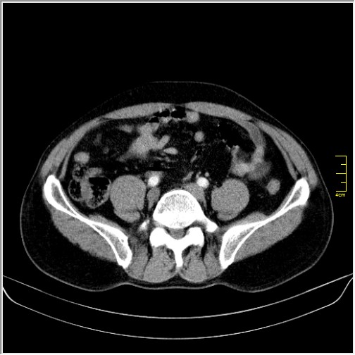 Obstruction due to small bowel bezoar (Radiopaedia 59583-66981 A 105).JPG