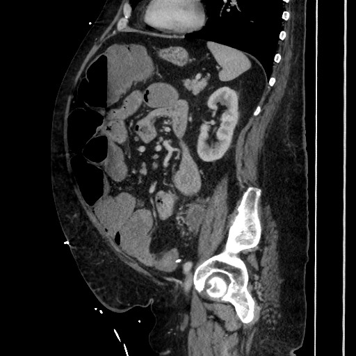 Obstructive colonic diverticular stricture (Radiopaedia 81085-94675 C 156).jpg