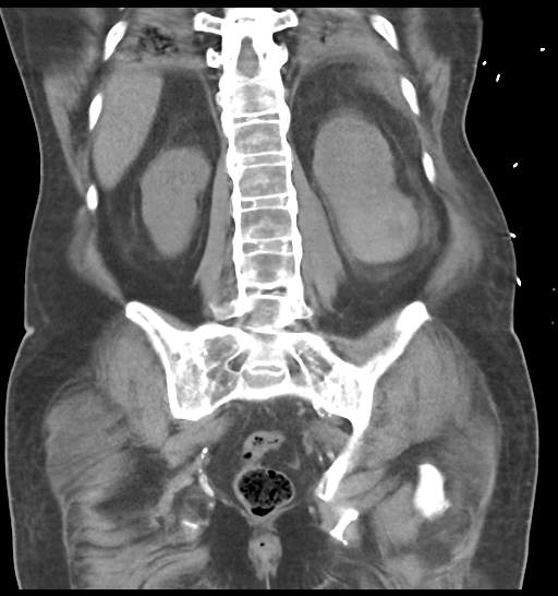 File:Obstructive pyelonephritis (Radiopaedia 46411-50844 Coronal non-contrast 47).png