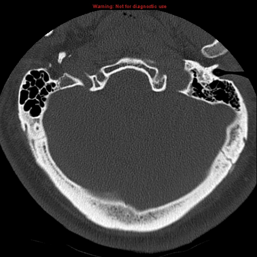 File:Occipital condyle fracture (Radiopaedia 18366-18208 Axial bone window 5).jpg