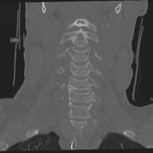 File:Occipital condyle fracture (Radiopaedia 33467-34517 Coronal bone window 24).png