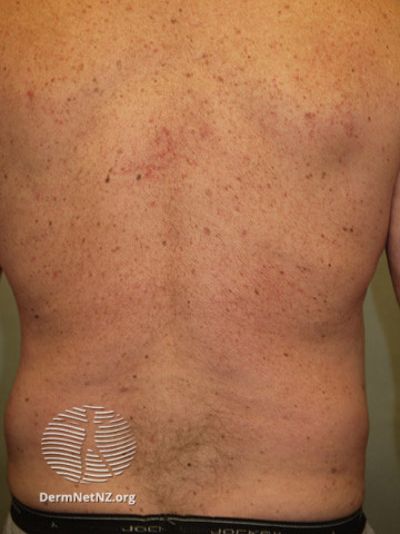 File:Psoriasis 6 months after commencing adalimumab (DermNet NZ treatments-adalimumab8).jpg