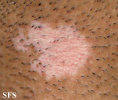 File:Vitiligo (Dermatology Atlas 30).jpg