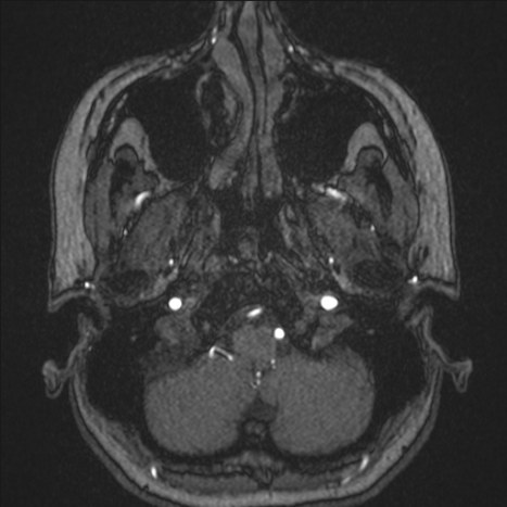 A1 segment hypoplasia (Radiopaedia 83365-97781 Axial TOF MRA 4).jpg