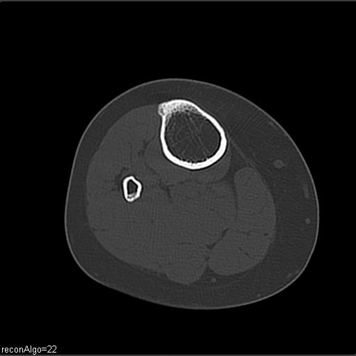 File:ACL avulsion fracture (Radiopaedia 33833-34994 Axial bone window 28).jpg