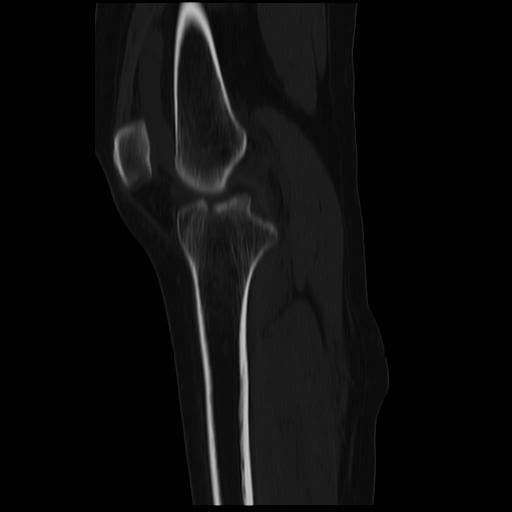 File:ACL avulsion fracture (Radiopaedia 33833-34994 Sagittal bone window 27).jpg