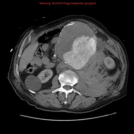 Abdominal aortic aneurysm- extremely large, ruptured (Radiopaedia 19882-19921 Axial C+ arterial phase 31).jpg
