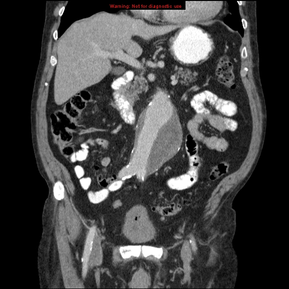 File:Abdominal aortic aneurysm (Radiopaedia 10122-10660 Coronal C+ portal venous phase 15).jpg
