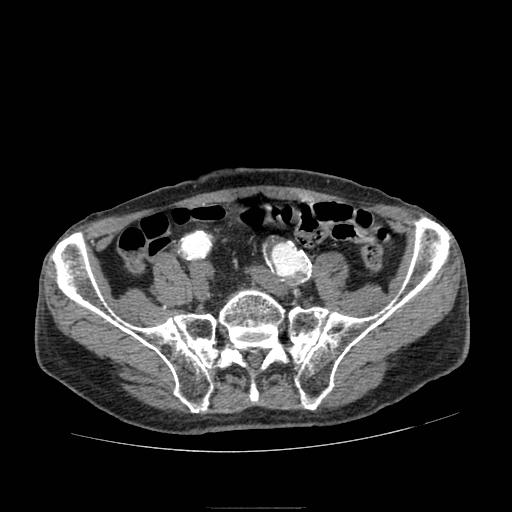 File:Abdominal aortic aneurysm (Radiopaedia 13341-13340 Axial C+ arterial phase 178).jpg