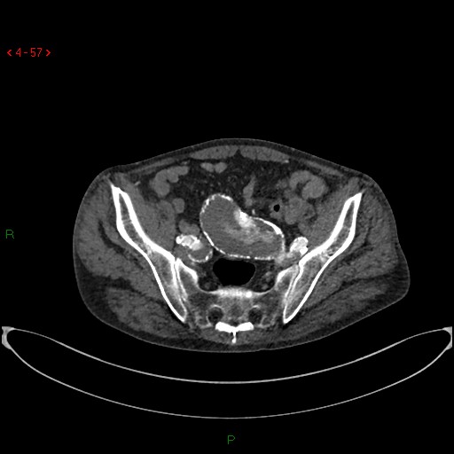 File:Abdominal aortic aneurysm (Radiopaedia 16155-15834 Axial C+ arterial phase 37).jpg