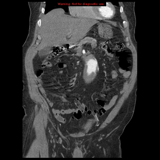 File:Abdominal aortic aneurysm (Radiopaedia 8190-9038 Coronal C+ arterial phase 38).jpg