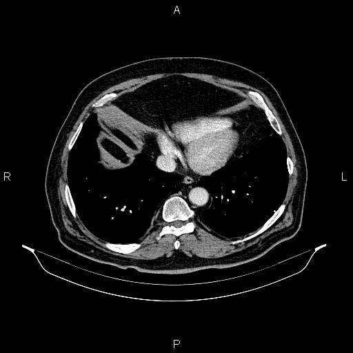 File:Abdominal aortic aneurysm (Radiopaedia 83094-97462 Axial renal cortical phase 57).jpg