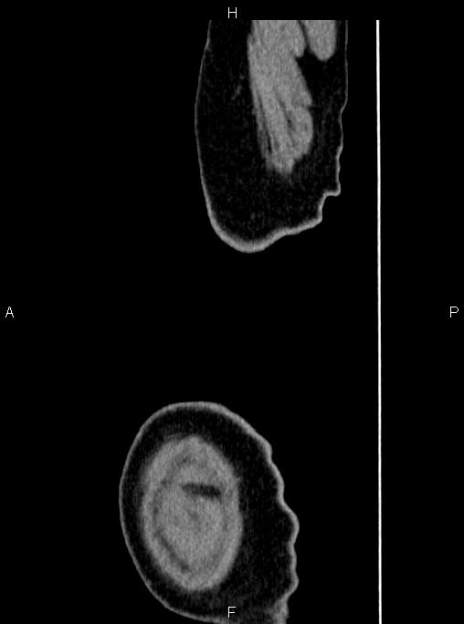 Abdominal aortic aneurysm (Radiopaedia 83094-97462 Sagittal renal cortical phase 128).jpg
