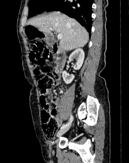 Abdominal aortic aneurysm (Radiopaedia 83581-98689 Sagittal C+ portal venous phase 11).jpg