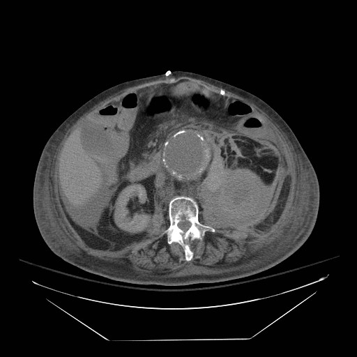 Abdominal aortic aneurysm - impending rupture (Radiopaedia 19233-19247 Axial non-contrast 85).jpg