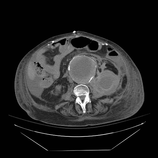 Abdominal aortic aneurysm - impending rupture (Radiopaedia 19233-19247 Axial non-contrast 94).jpg