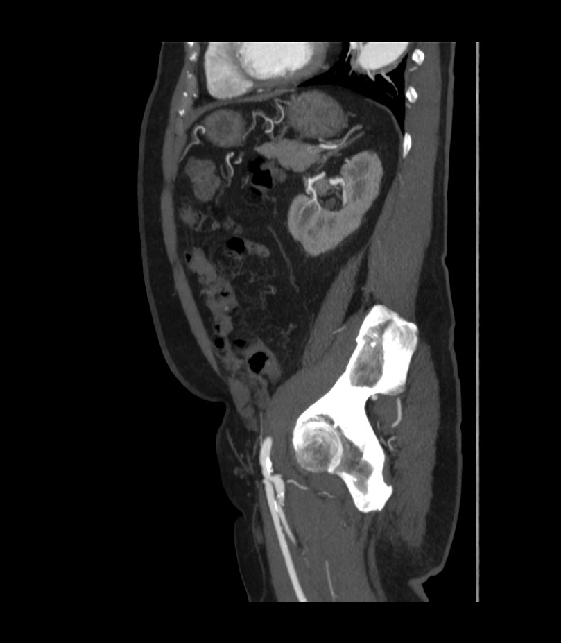 Abdominal aortic aneurysm with thrombus fissuration (Radiopaedia 46218-50618 Sagittal C+ arterial phase 42).jpg