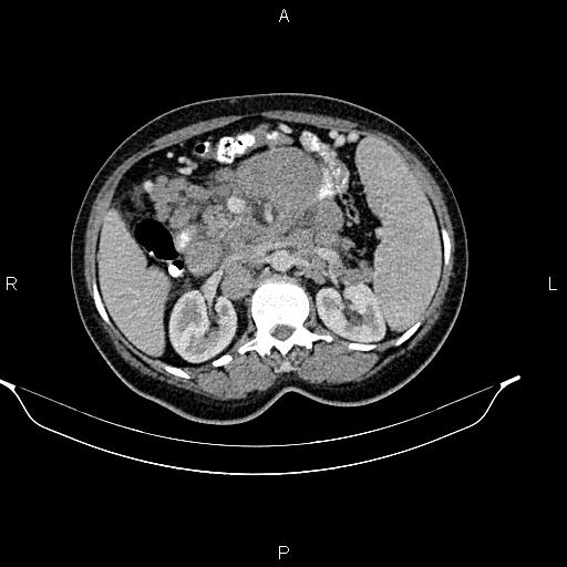 Abdominal lymphoma with sandwich sign (Radiopaedia 84378-99704 Axial C+ portal venous phase 22).jpg