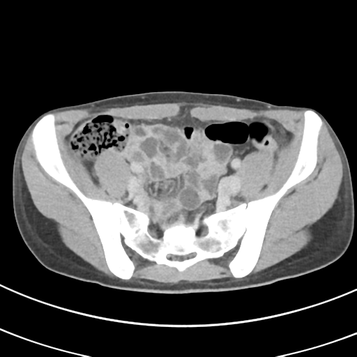 File:Abdominal multi-trauma - devascularised kidney and liver, spleen and pancreatic lacerations (Radiopaedia 34984-36486 Axial C+ delayed 61).png