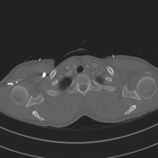 File:Abdominal multi-trauma - devascularised kidney and liver, spleen and pancreatic lacerations (Radiopaedia 34984-36486 I 11).png