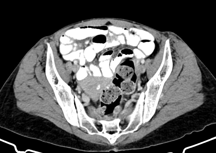 Abdominal wall and retroperitoneal tuberculosis (Radiopaedia 88137-104729 Axial C+ portal venous phase 153).jpg