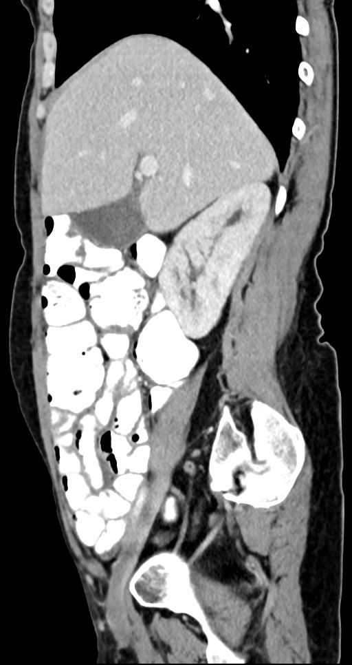 Abdominal wall and retroperitoneal tuberculosis (Radiopaedia 88137-104729 Sagittal C+ portal venous phase 101).jpg