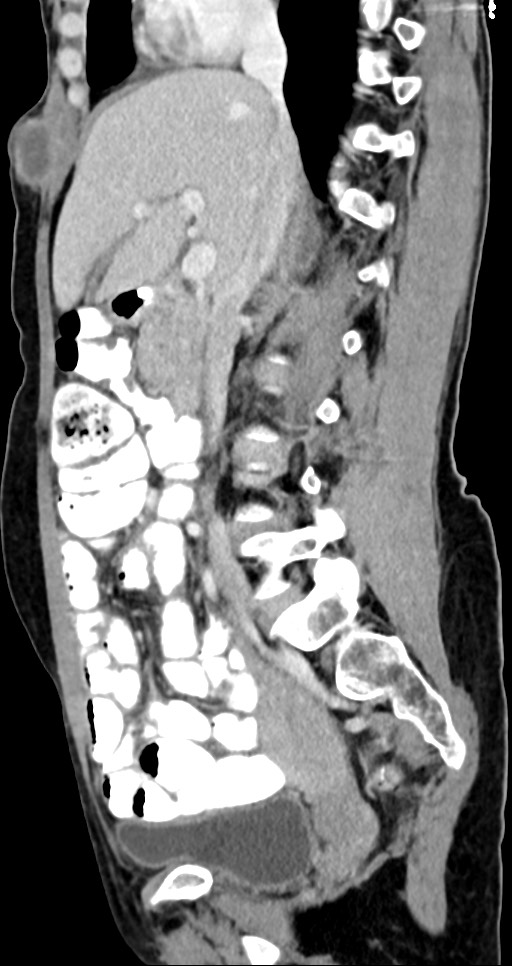 Abdominal wall and retroperitoneal tuberculosis (Radiopaedia 88137-104729 Sagittal C+ portal venous phase 89).jpg