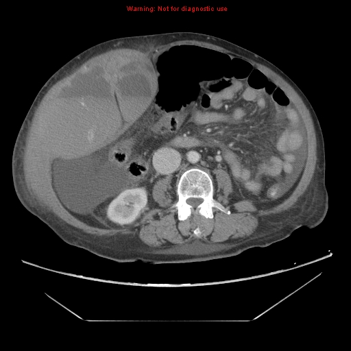 File:Abdominal wall hematoma (Radiopaedia 9427-10112 Axial C+ portal venous phase 55).jpg