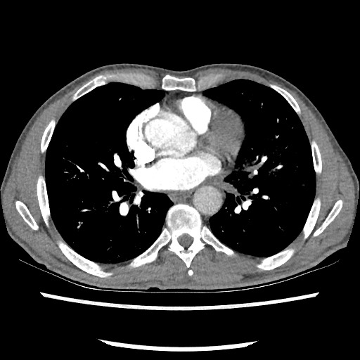 File:Accessory left horizontal fissure with lingular pneumonia (Radiopaedia 53763-59843 Axial C+ CTPA 54).jpg